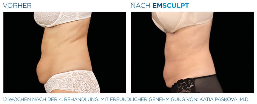 EMSculpt Vorher-Nachher Fotos: Bauch nach 4 Behandlungen