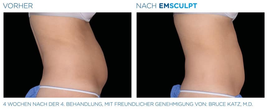 EMSculpt Vorher-Nachher Fotos: Bauch nach der 4. Behandlung