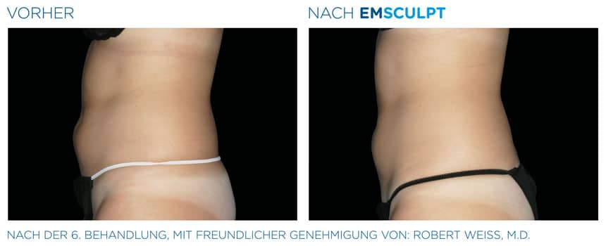 EMSculpt Vorher-Nachher Fotos: Bauch nach der 6. Behandlung