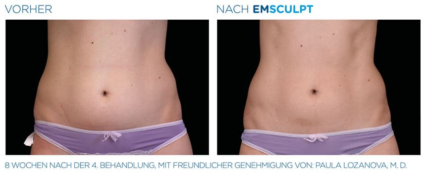 EMSculpt Vorher-Nachher Fotos: Bauch nach der 4. Behandlung