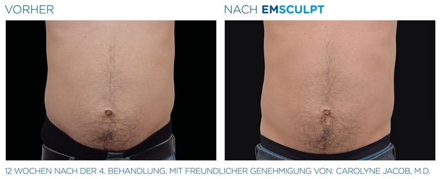 EMSculpt Vorher-Nachher Fotos: Bauch nach 4 Behandlungen