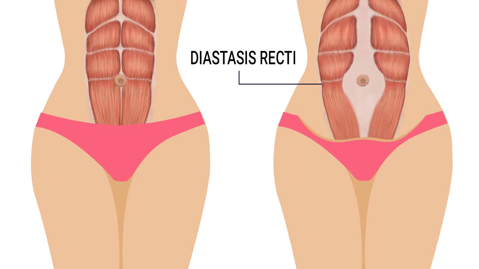 Diastasis recti – Die Rektusdiastase mit EMSCULPT behandeln