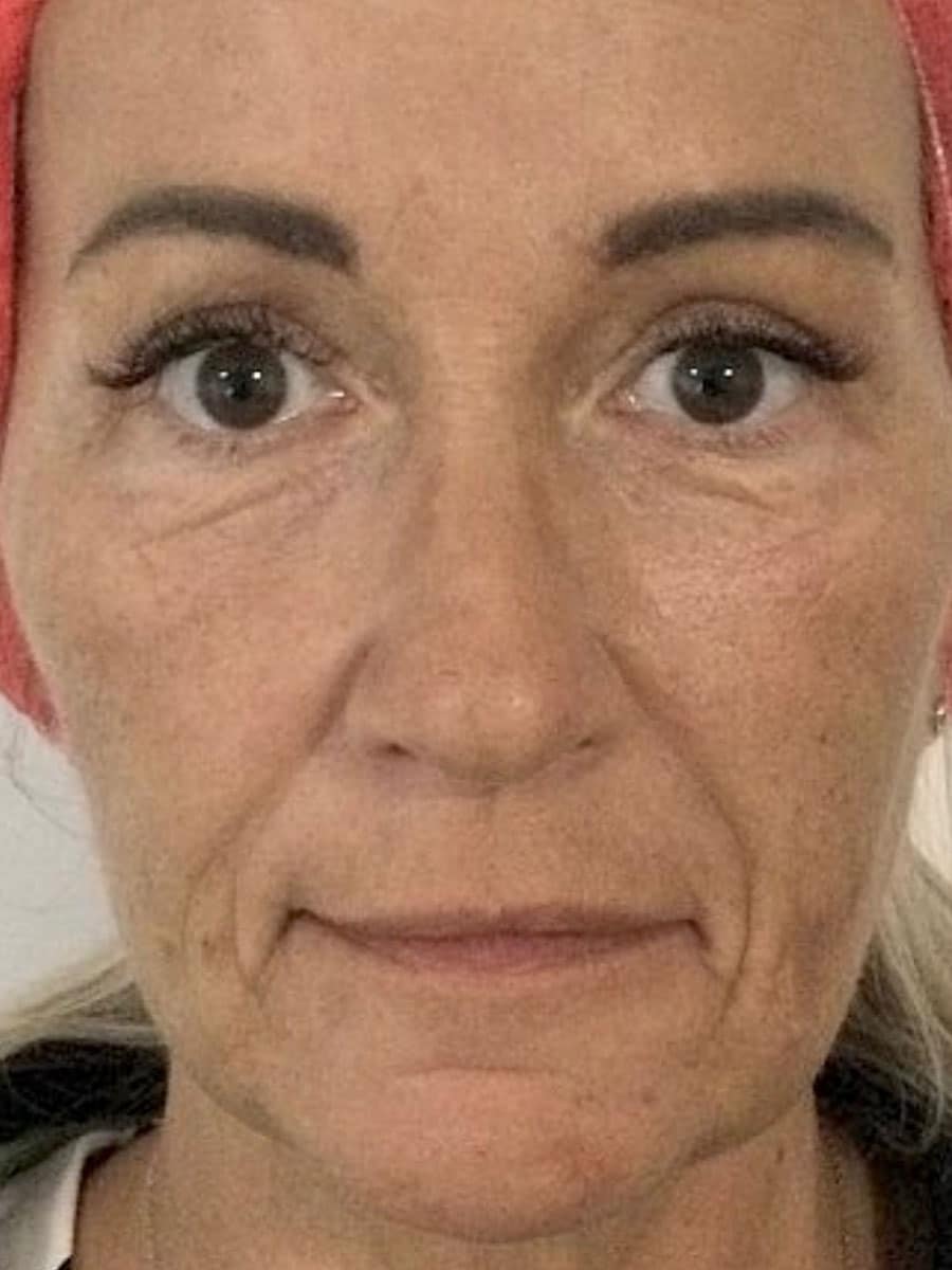 Gesicht einer Frau nach der Behandlung mit HarmonyCA Filler bei Omnimed
