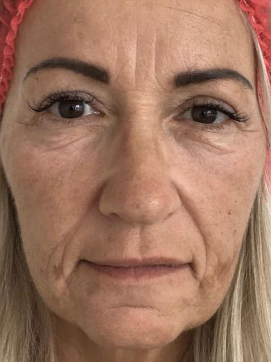 Gesicht einer Frau vor der Behandlung mit HarmonyCA Filler bei Omnimed