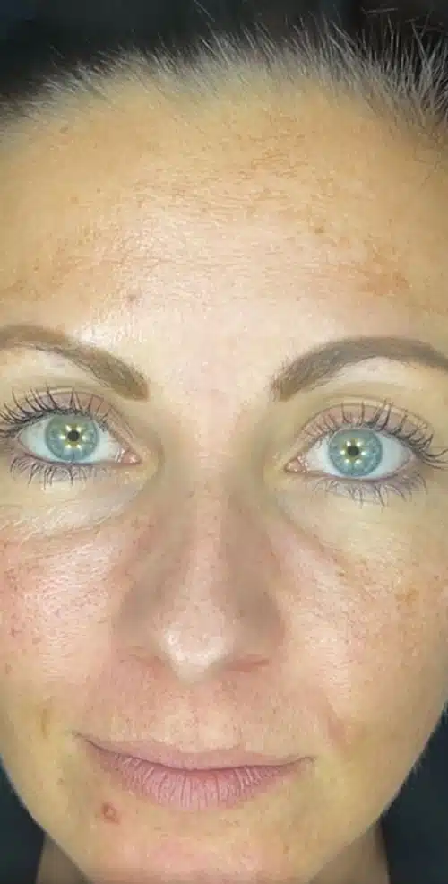 Gesicht einer Frau vor der Behandlung mit LAVIEEN im Oktober 2023